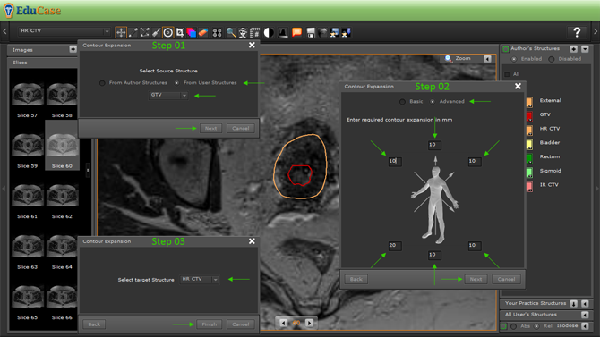 EduCase, Features, Contouring Tools, Expansion Tools for DICOM contours
