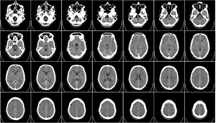 CT Anatomy of the Skull Base