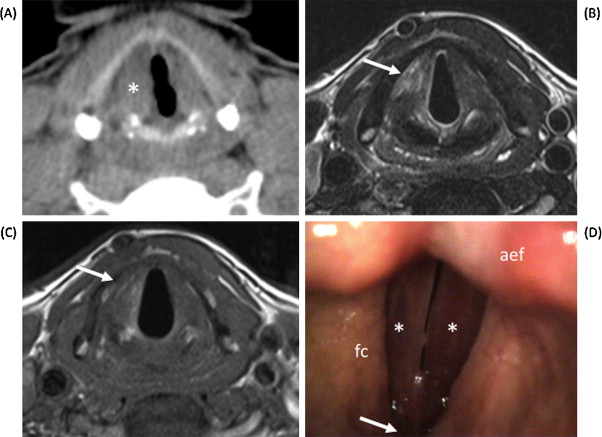 Laryngectomy vs Preservation