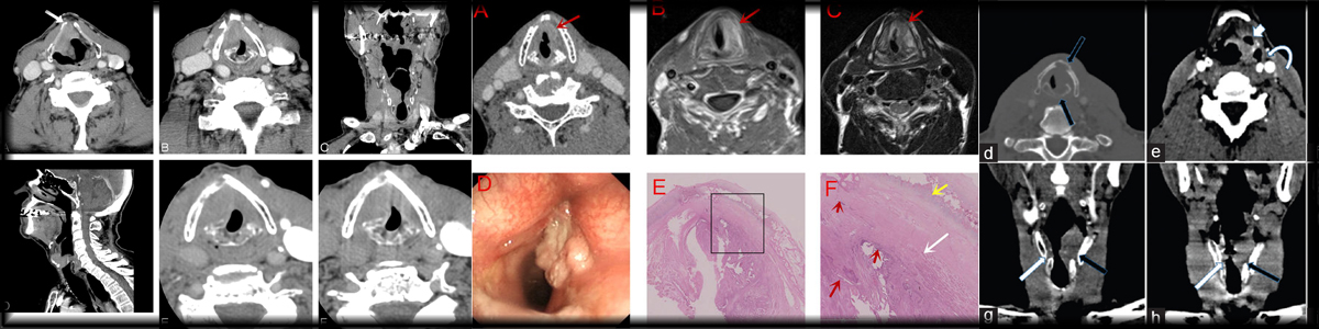 Fiberoptic examination for the radiation oncologist