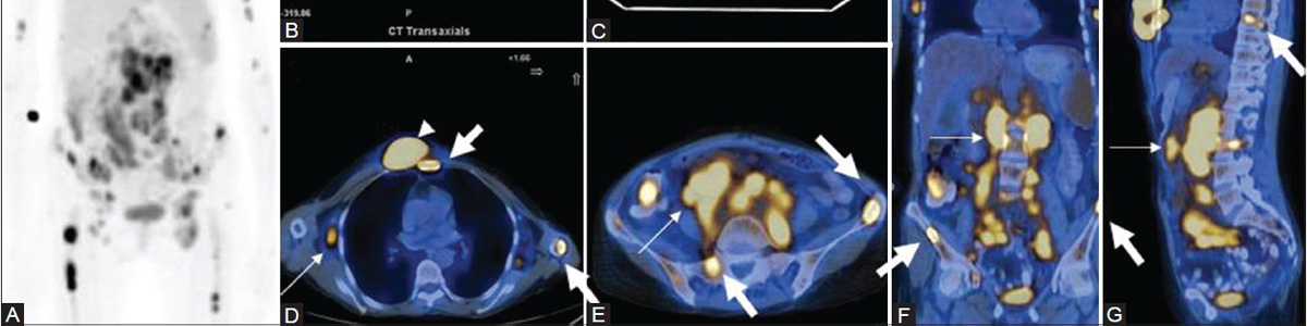 Stage I-II Follicular lymphoma